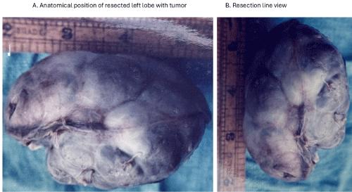 Congenital Neonatal Infected and Bleeding Hepatic Hamartoma Presenting as a Falciform Ligament Abscess, Successfully Treated by Emergency Left Hepatic Lobectomy, with Subsequent Development of Infantile Hemihypertrophy