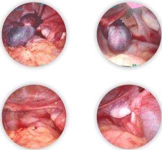 Pediatric Ovarian Torsion in an 8-Year-Old Girl: A Rare Case Report and Clinical Insights