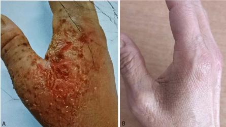 Efficiently Curing Dyshidrosis