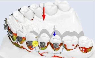 The Hot Tooth Paradox of Thermal Gradient‑Driven Implant Fracture