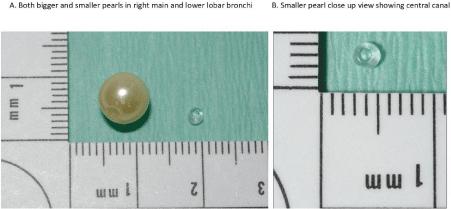 A Complex Pediatric Case of Pulmonary Vascular Hypertension Following Foreign Body Inhalation, Viral‑Induced Wheeze, Micronutrient Deficiencies, Immune Dysfunction and Colorectal Motility Disorder in a Toddler Simulating Status Asthmaticus