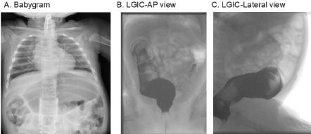 Motility Disorder, Meckel’s Diverticulum and Mass in a Toddler Girl-Mere Coincidence or Causation Link