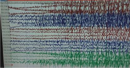 Bathing-Related Reflex Epilepsy in a Young Adult: First Reported Case from Palestine