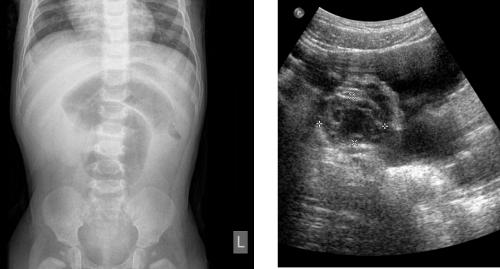 Familial Hypoganglionosis Presenting as Maternal Chronic Intestinal Dysmotility with Co‑Occurring Subacute Combined Degeneration and Severe Anemia, and Acute Intussusception in Her Infant Daughter: A Two‑Generation Case Series