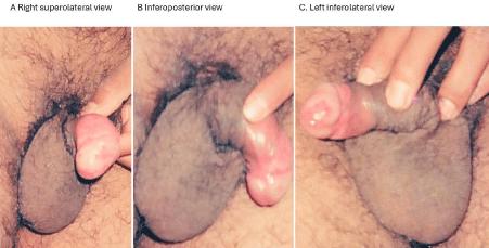 Recurrent Pelvic Inflammatory Disease and Resistant Balanoposthitis Secondary to a Variant Low Female Anorectal Malformation: An Unusual Cause of Primary Infertility in an Adult Couple