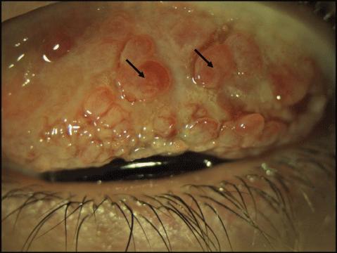 Vernal Conjunctivitis