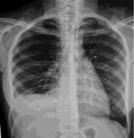 Malignant Pleural Mesothelioma in Women: A Case Report