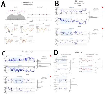 Canalith Repositioning Maneuvers with Vestibular Rehabilitation for Bilateral Posterior Canal BPPV Secondary to Otitis Media in an Older Adult: A Case Report