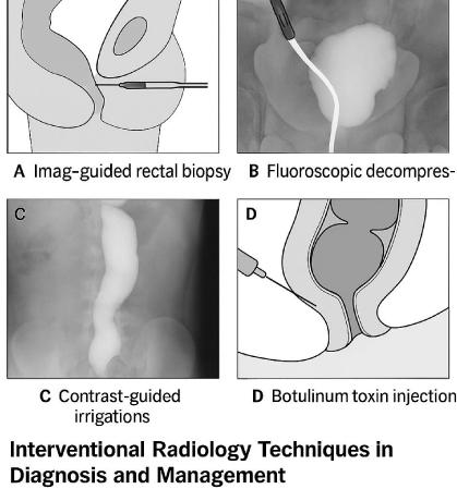Radiological Imaging in Hirschsprung’s Disease, Its Variants, and Colorectal Motility Disorders: A Comprehensive Review of Diagnostic Findings and Interventional Applications