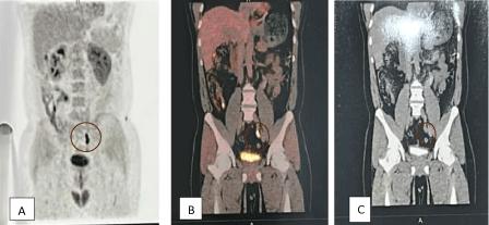 Organ-Preserving Management of Primary Lynch Syndrome–Associated High-Grade Upper Tract Urothelial Carcinoma Using Gemcitabine–Cisplatin and Pembrolizumab: First Reported Case Worldwide